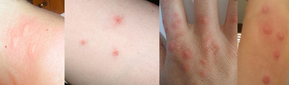 bed bugs